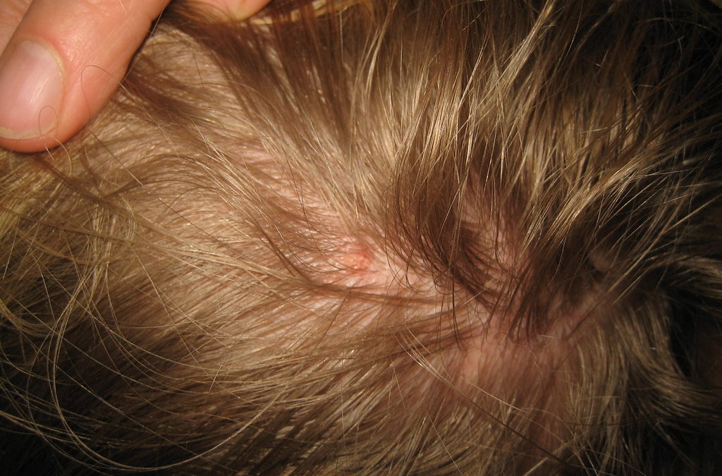 lice in home